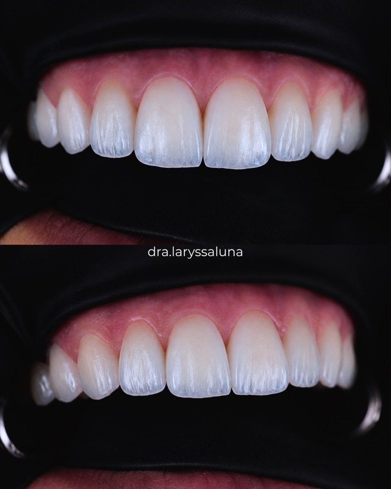 Resultado de lentes de resina com aparência natural